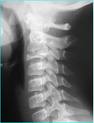 Ostéopathie: Traitement des Cervicalgies, Douleurs Cervicales en Ostéopathie Ostéopathie: Traitement des Cervicalgies, Douleurs Cervicales en Ostéopathie
