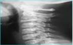 Ostéopathie: Traitement des Cervicalgies, Douleurs Cervicales en Ostéopathie