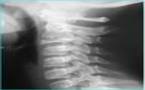 Ostéopathie: Traitement des Cervicalgies, Douleurs Cervicales en Ostéopathie Ostéopathie: Traitement des Cervicalgies, Douleurs Cervicales en Ostéopathie