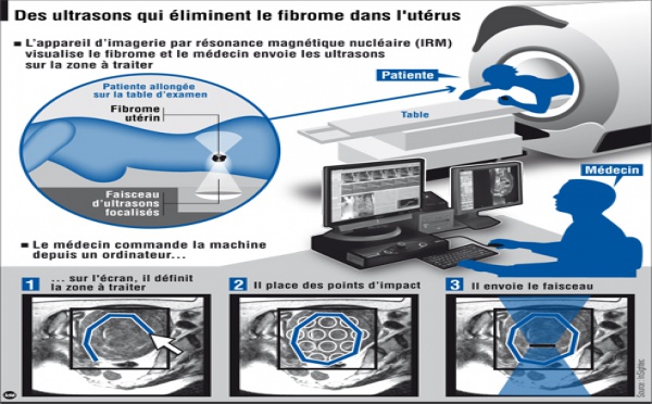 Détruire des tumeurs bénignes sans chirurgie ni anesthésie. Traitement anti-cancer, une petite révolution Israelienne, une grande évolution pour l'Humanité